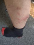 Красные пятна на икре ноги (сильная боль) фото 1