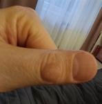 Грибок на сгибе фаланга пальца руки фото 1