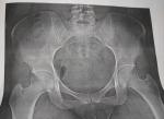 Рентген тазобедренного сустава фото 3