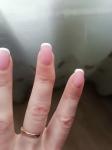После пореза пальца на сгибе, палец стал кривым фото 1