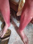 Солнечный ожог на ноге сильно воспалился фото 1