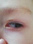 Воспаление глаз, конъюнктивит, слезное мясцо красное фото 2