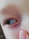 Воспаление глаз, конъюнктивит, слезное мясцо красное фото 1