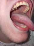 Рак языка или воспаление фото 1