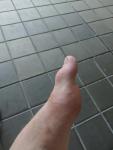 Перелом пальца ноги фото 3