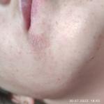 Как вылечить пятно возле губы фото 1