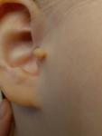 Папиллома на ухе с рождения фото 2
