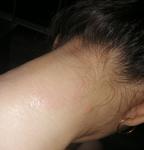 Аллергия на шее фото 1