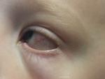 Красный глаз у ребёнка фото 2
