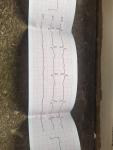Расшифровка кардиограммы, постоянно болит спина и отдает в сердце фото 2