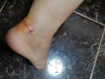 Опухоль ноги после наложения швов после 10дней фото 1