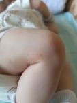Красные пятна на ноге младенца 2мес, растут фото 1