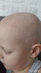 Сильная сыпь на голове ребенка фото 4