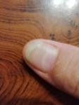 Как лечить грибок ногтей рук? фото 2