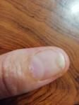 Как лечить грибок ногтей рук? фото 1