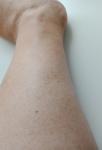 Не проходящее тёмное пятно более 8 месяцев только на левой ноге фото 4