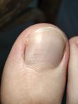 Пятно на ногте большого пальца ноги фото 3