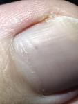 Пятно на ногте большого пальца ноги фото 2