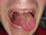 Стоматит рта гной фото 2