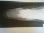 Сложный перелом пяточной кости фото 2