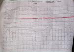 Расшифровка ЭКГ и перебои в сердце регулярные фото 1
