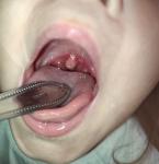 Налет в горле у ребенка фото 1