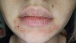 Красная сыпь болит в уголках рта и под нижней губой фото 1