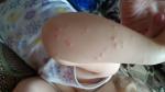 Странная сыпь у ребёнка, нет точного диагноза фото 2
