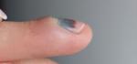 Ушиб пальца, гематома, нужно ли обращатьс к врачу фото 2