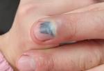 Ушиб пальца, гематома, нужно ли обращатьс к врачу фото 1