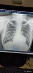Расшифровка снимка флюорографии лёгких фото 2