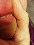 Черный узелок на внутренней стороне верхней губы фото 1