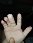Облазить кожа на пальчиках рук фото 2