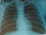 Длительный кашель, рентген фото 1