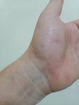 Пятна на суставах пальцев рук фото 2