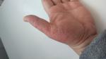 Покраснение шелушение и сухость рук вплоть до микротрещин фото 2