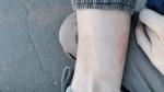 Коричневые пятна на ноге фото 1