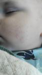 Высыпания на кожных покровов лица, подозрение на атопический дерматит фото 1