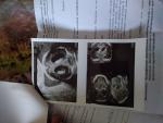 Гидроцефалия у плода на 22 недели беременности фото 2