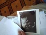 Гидроцефалия у плода на 22 недели беременности фото 1