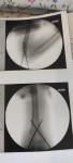 Перелом плечевой кости со смещением фото 1