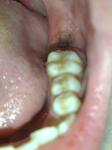 Лунка после удаления зуба. Есть ли воспаление? фото 1