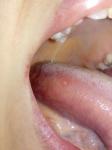 Болит сильно язык и лимфоузлы фото 1