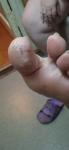 Коричневые пятнышки на больших пальцах ног фото 1