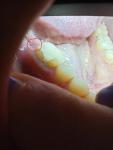 В лунке зуба участок темнее фото 2