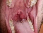 Гнойная шишка в горле фото 1