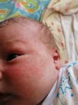 Сыпь акне или аллергия на лице у новорожденного фото 3
