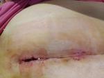 Кровит шов после полосной операции седьмые сутки фото 2