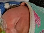 Сыпь акне или аллергия на лице у новорожденного фото 1