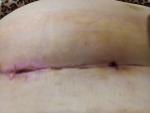 Кровит шов после полосной операции седьмые сутки фото 3